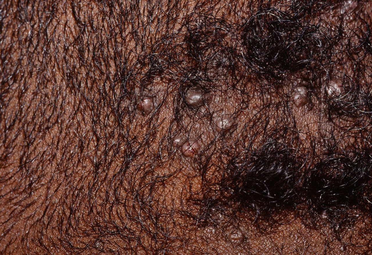 Acne keloidalis nuchae