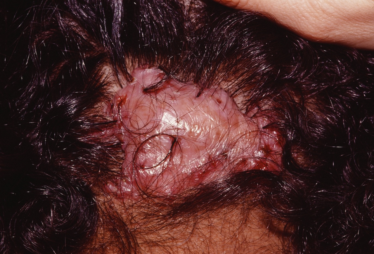Acne keloidalis nuchae
