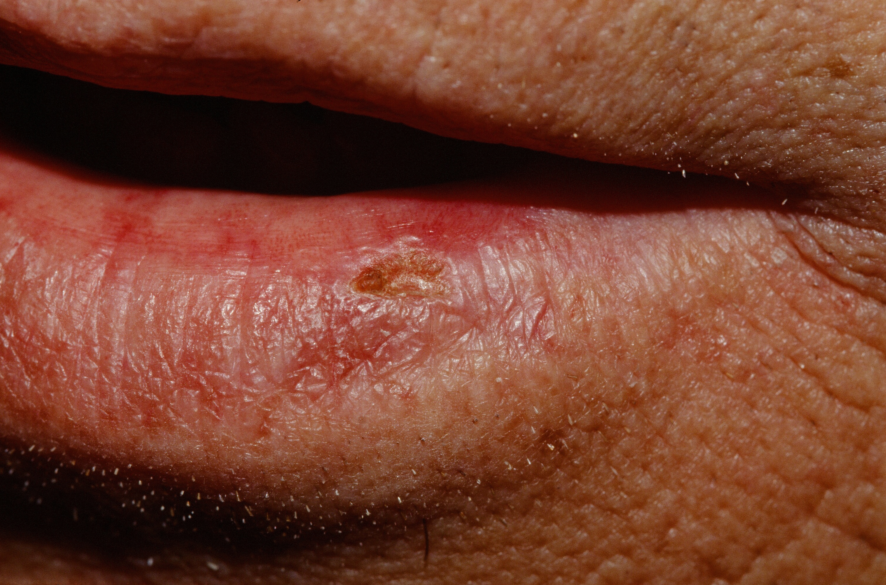 Actinic Cheilitis