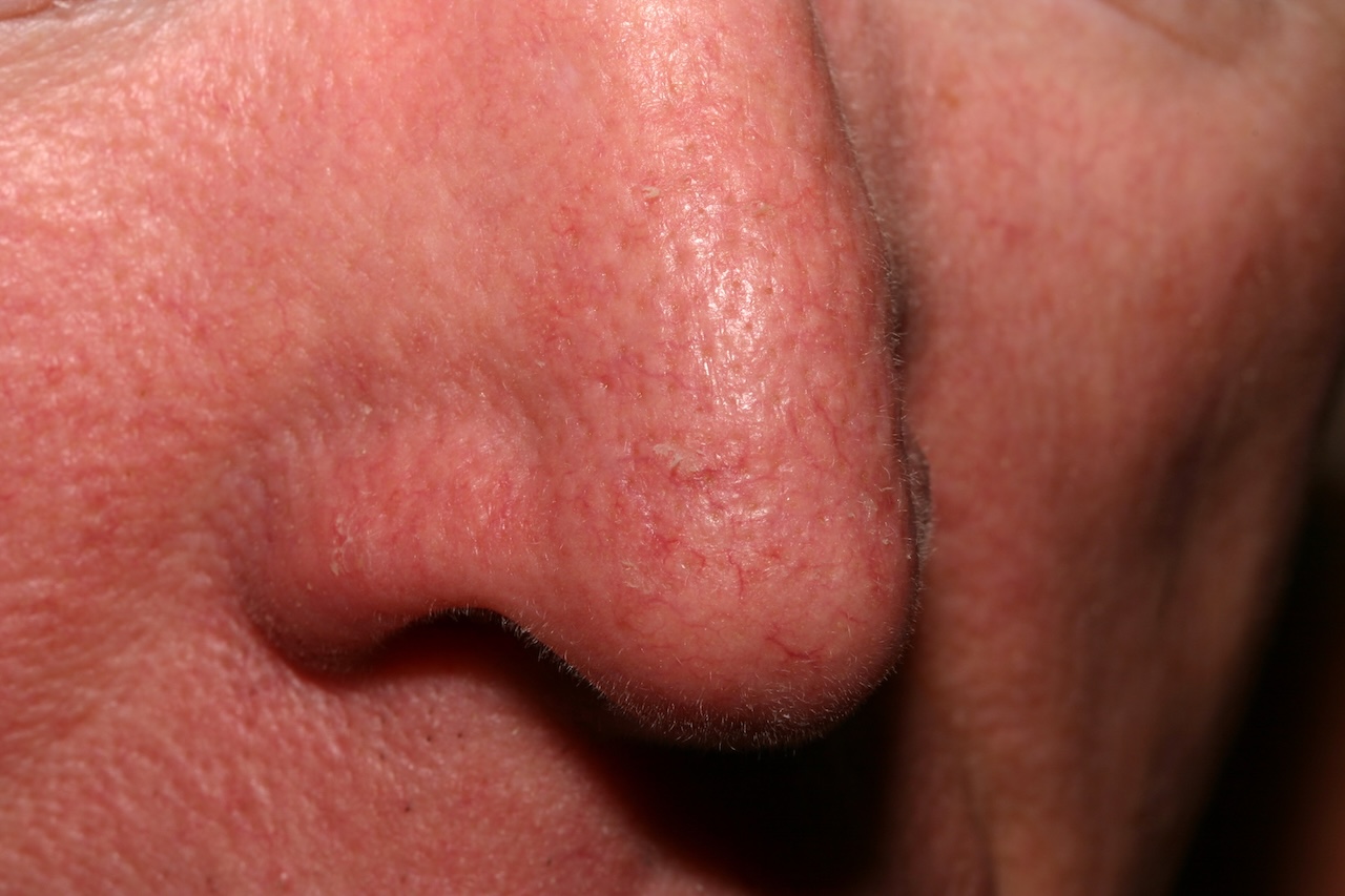 actinic keratosis on the nose
