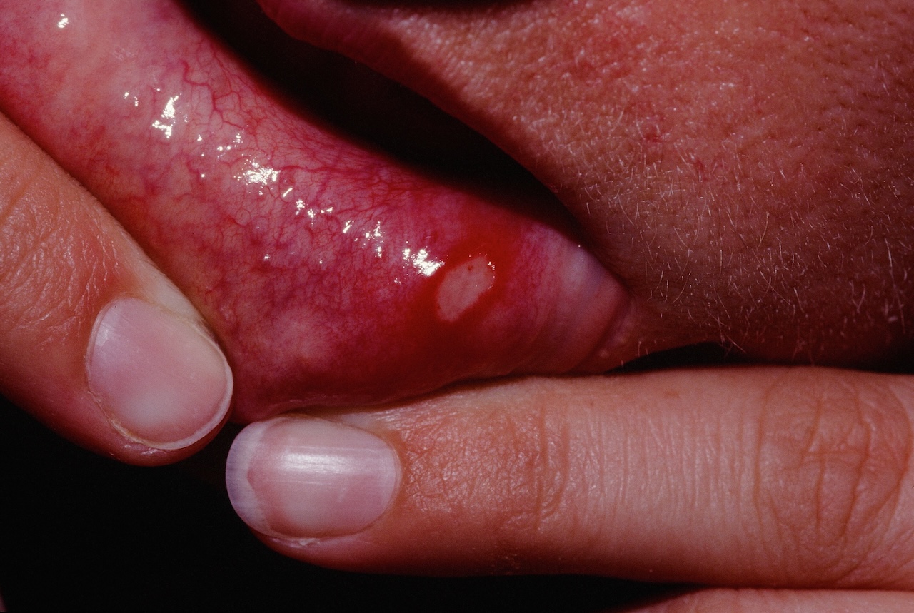 Aphthous Ulcer