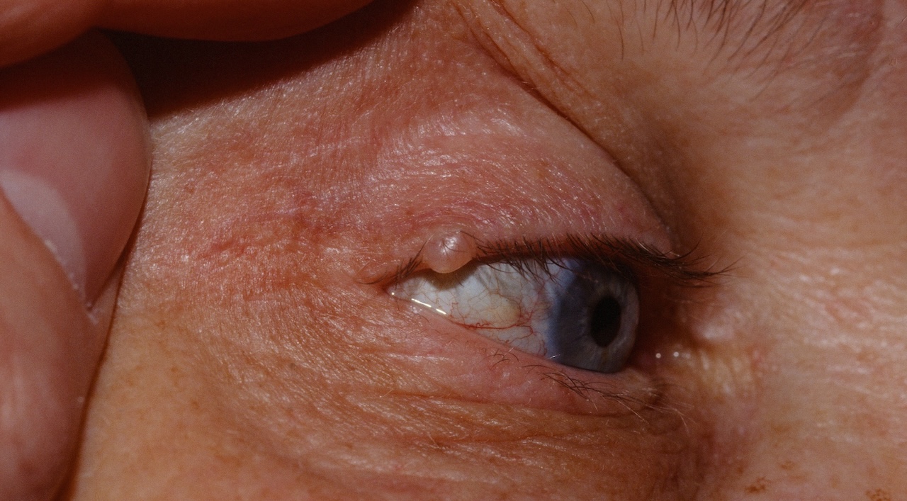 Apocrine Hidrocystoma