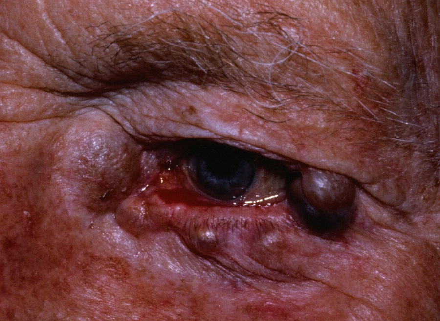 Multiple apocrine hidrocystomas