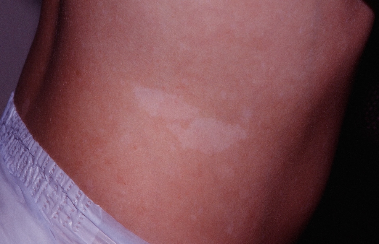 Ash Leaf Macule