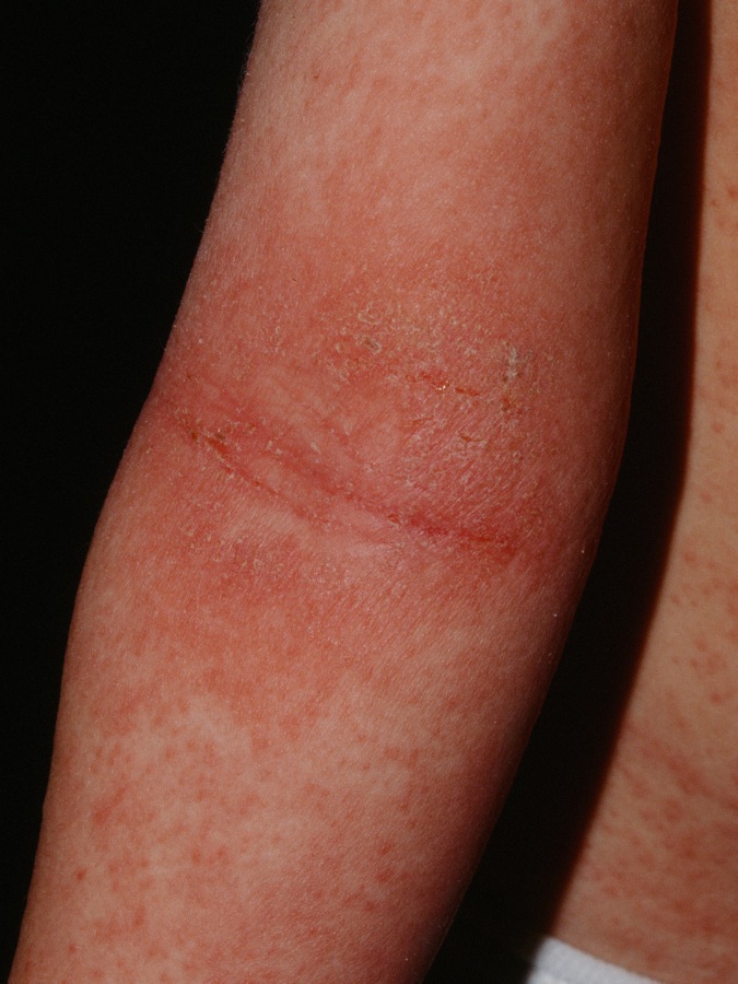 Atopic Dermatitis
