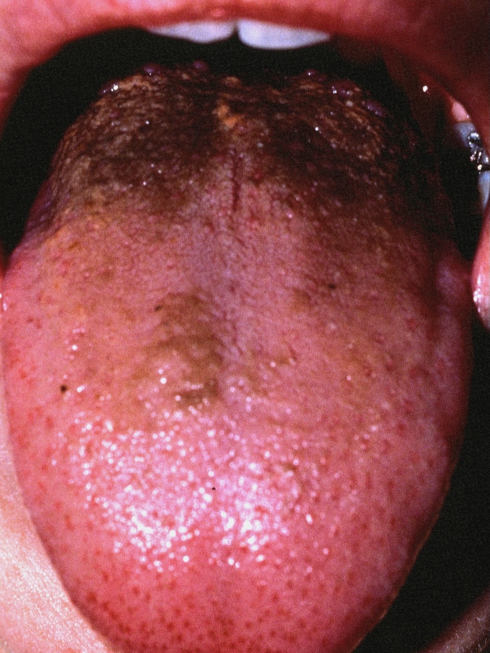Black Hairy Tongue