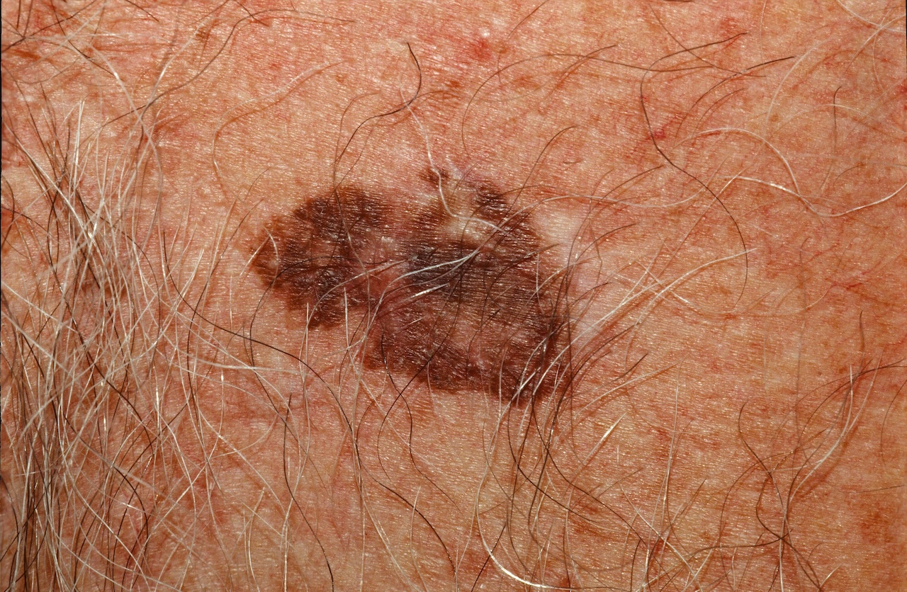Pigmented Bowen's Disease