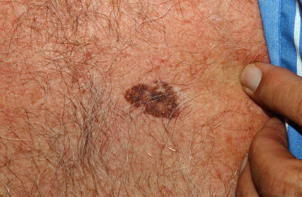 Pigmented Bowen's Disease