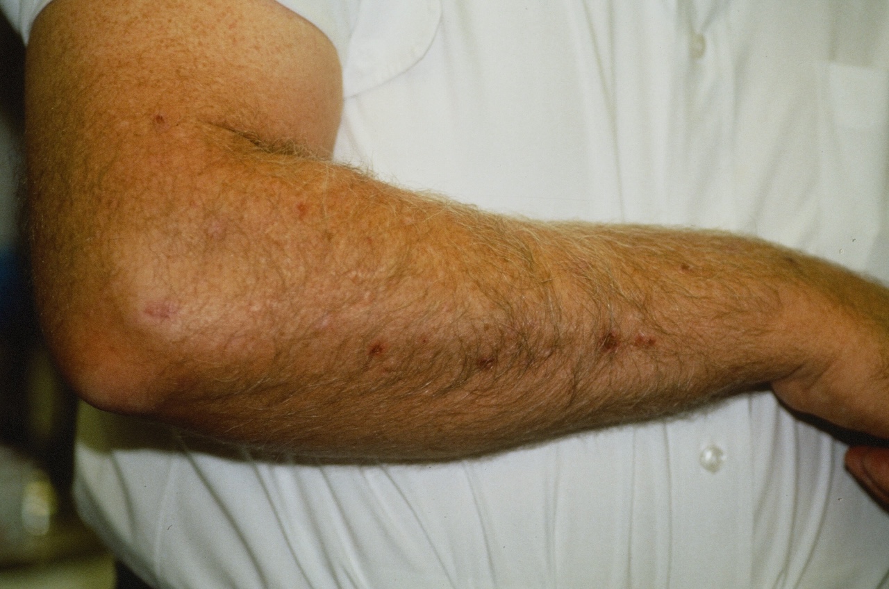 Brachioradial Pruritus