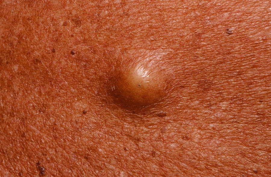 epidermal inclusion cyst
