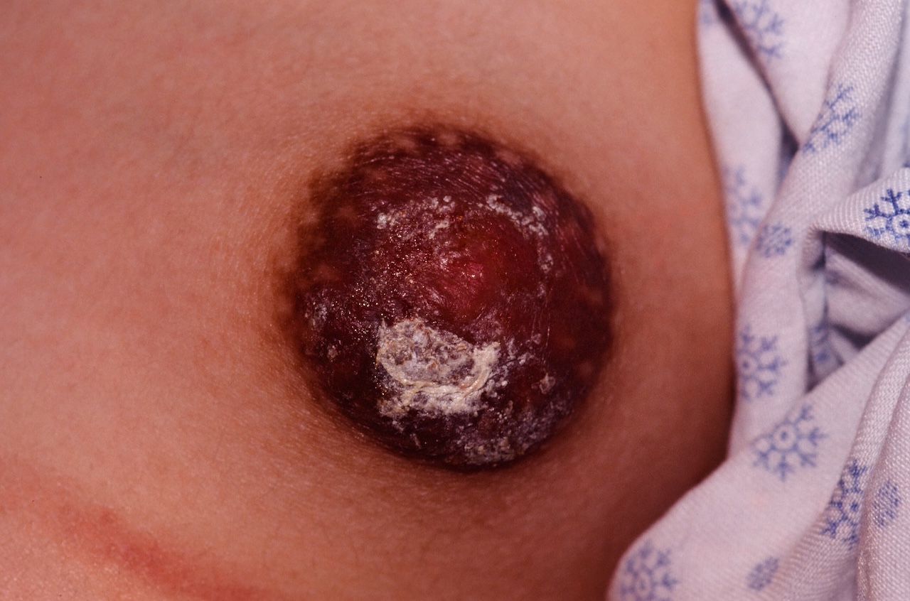 Eczema of the Nipple
