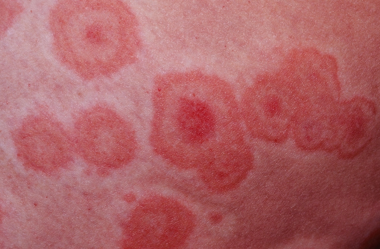 Erythema Multiforme