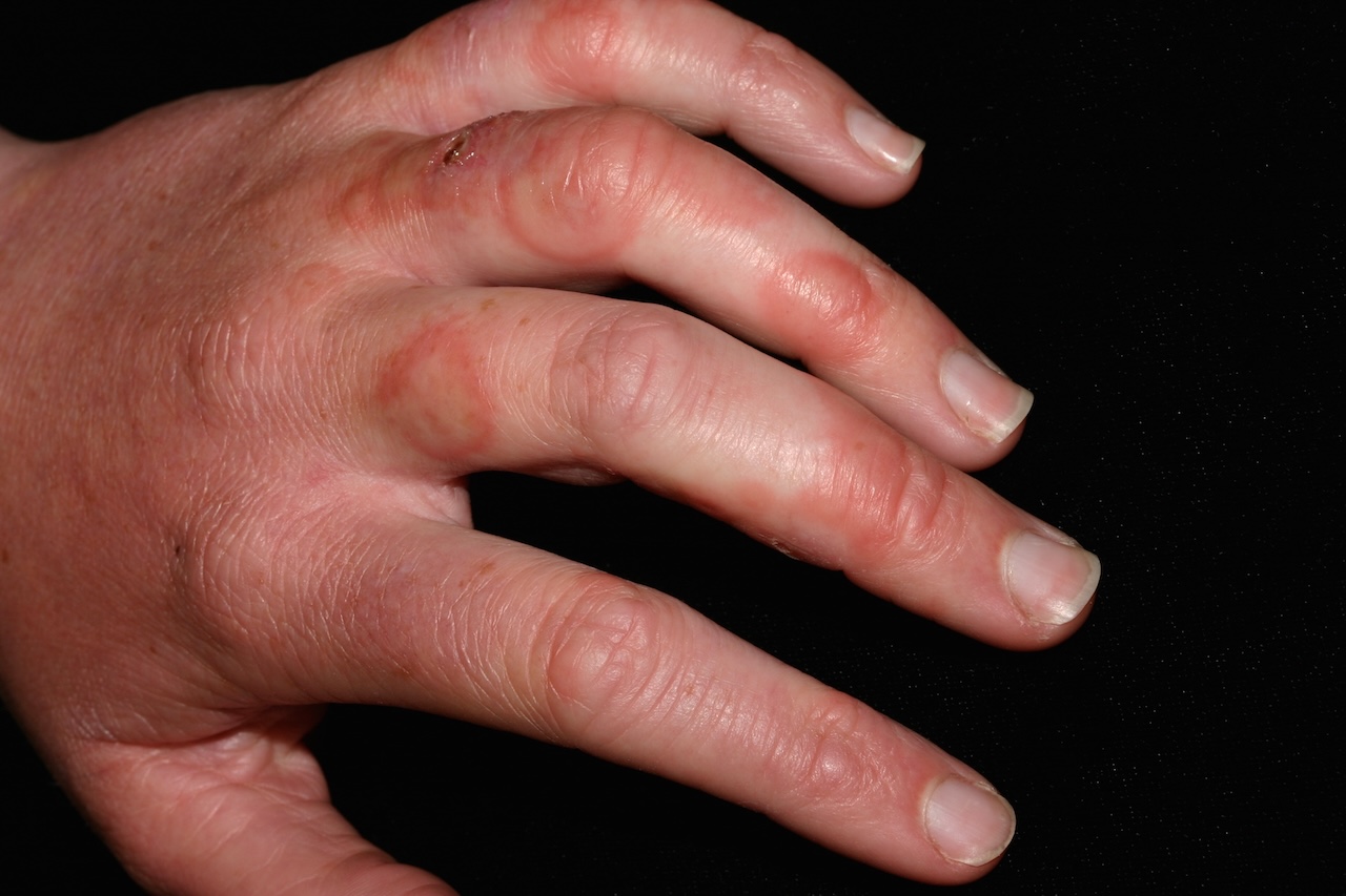 Erythema Multiforme