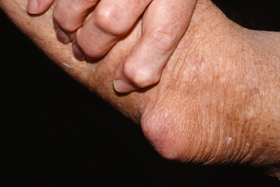 Gout