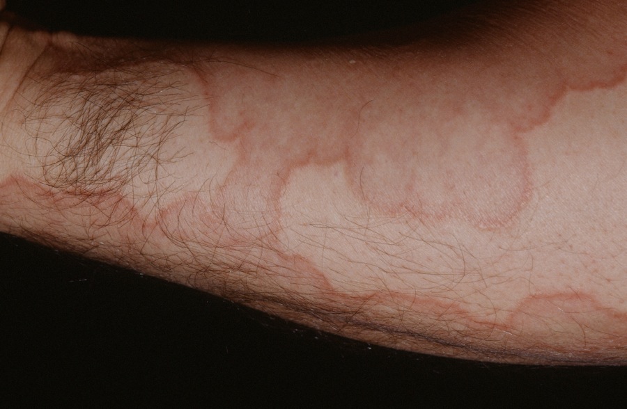 Granuloma Annulare