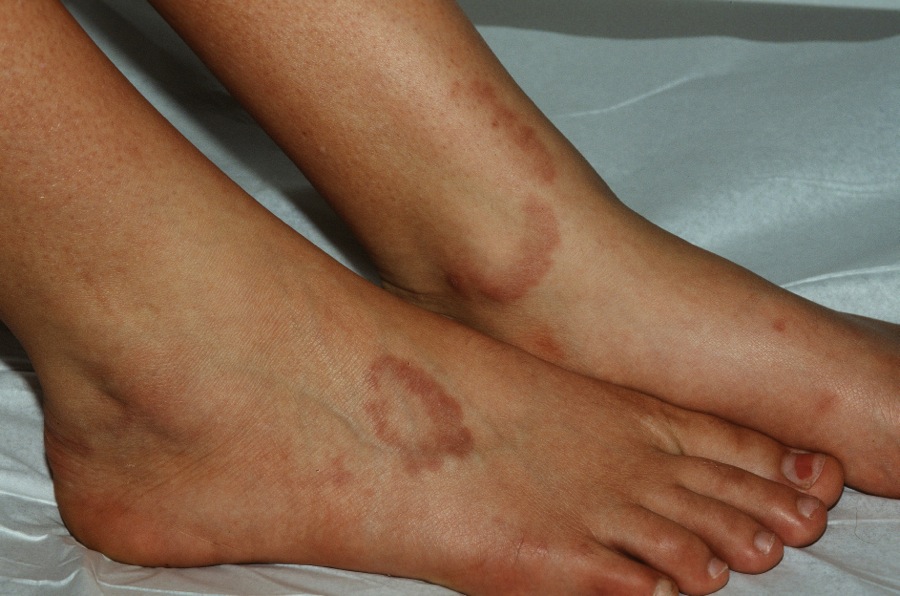 Granuloma Annulare