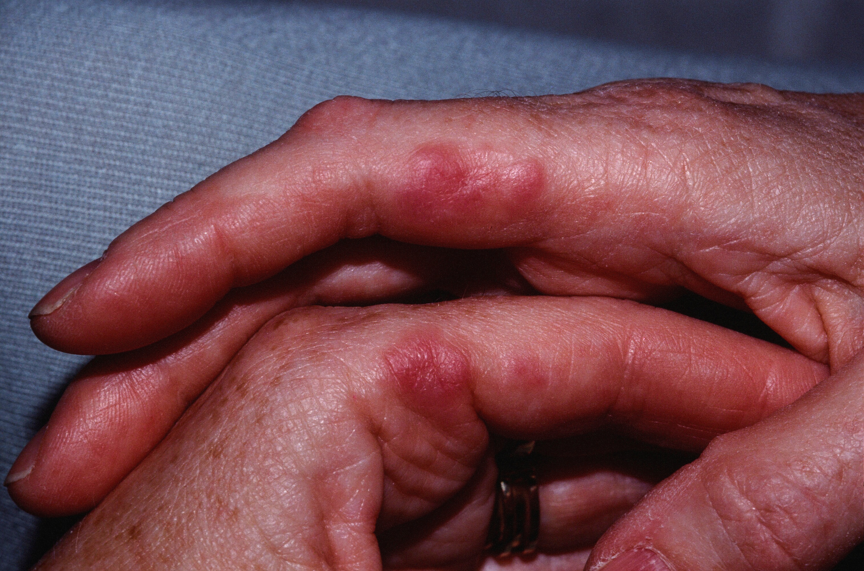 Granuloma Annulare