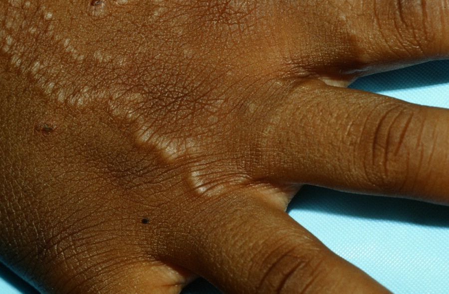 Granuloma Annulare