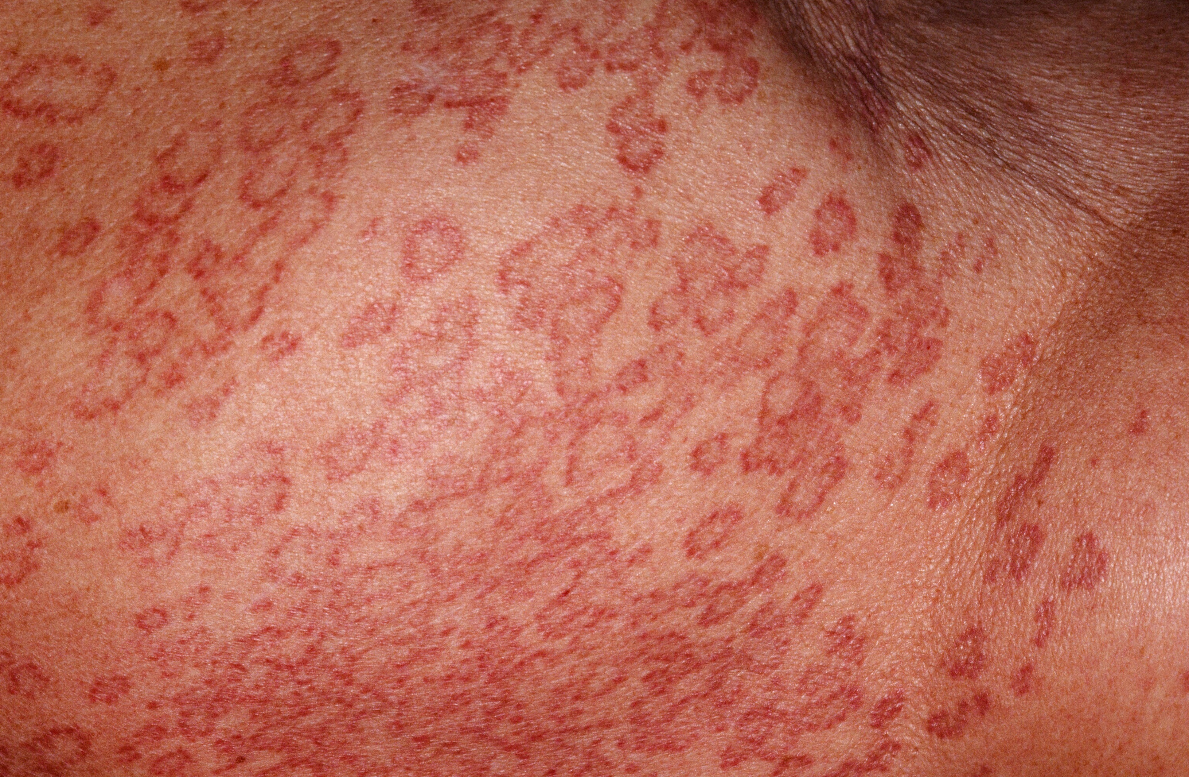 Granuloma Annulare