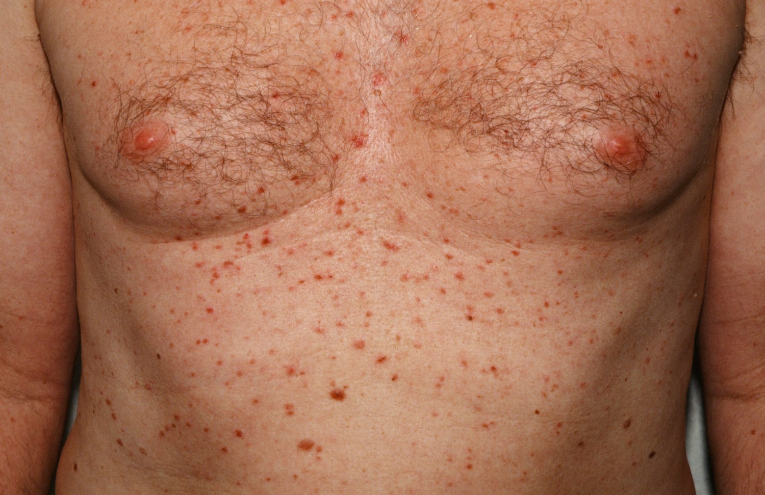 Grovers Disease