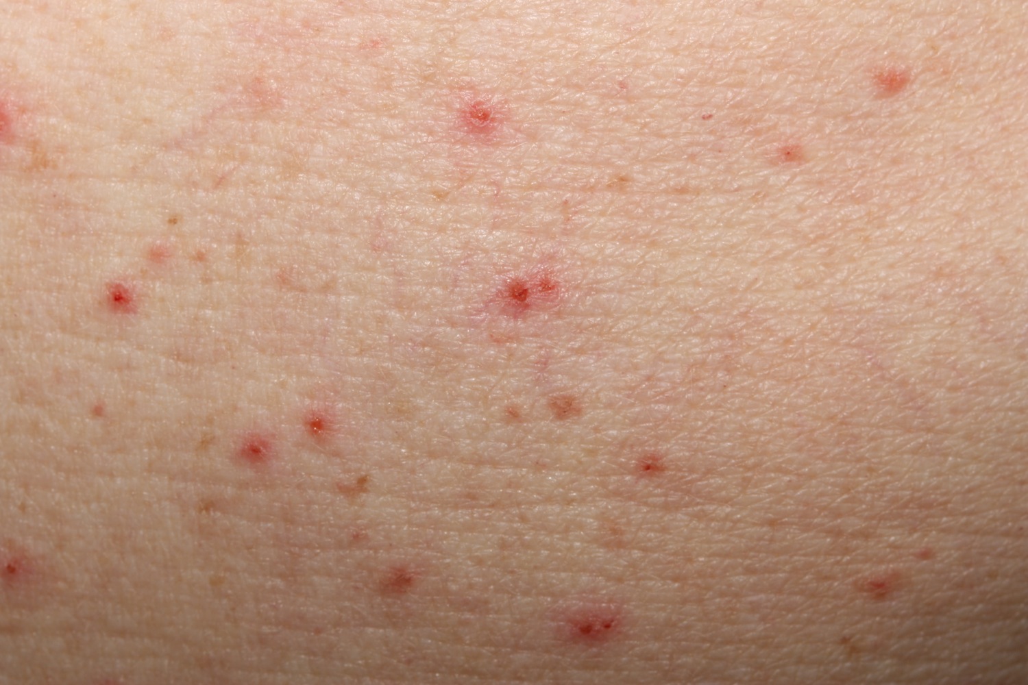 Grovers Disease
