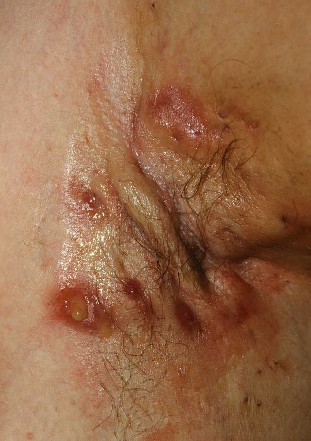 Hidradenitis Suppurativa