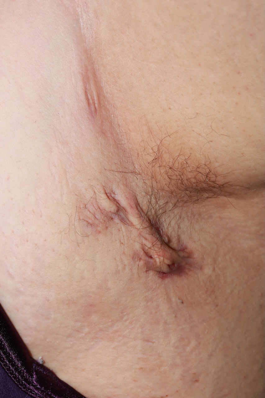 Hidradenitis Suppurativa