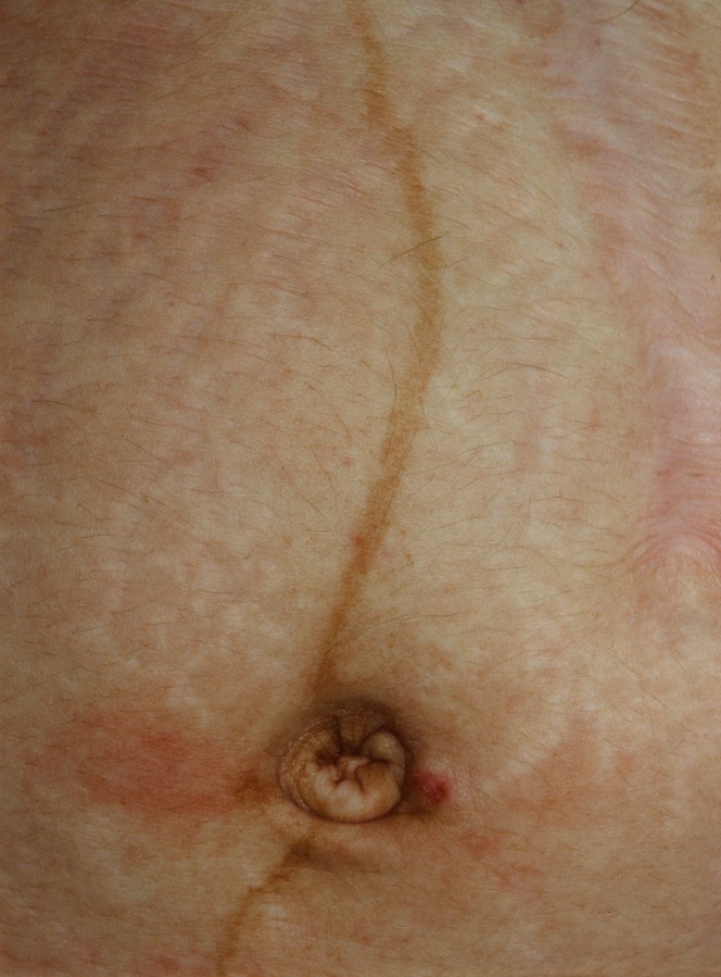 Linea Nigra