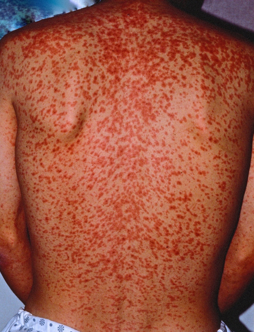 Measles