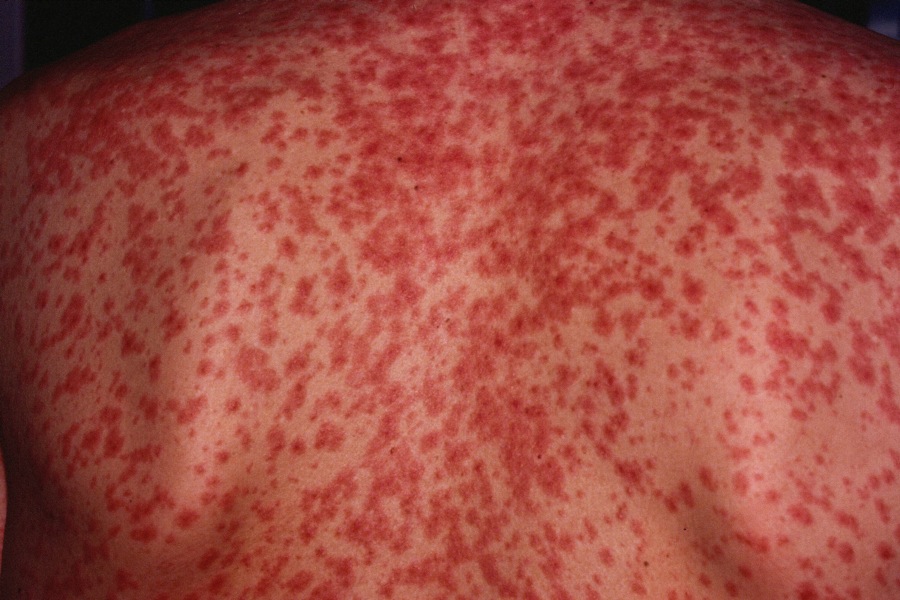 Measles