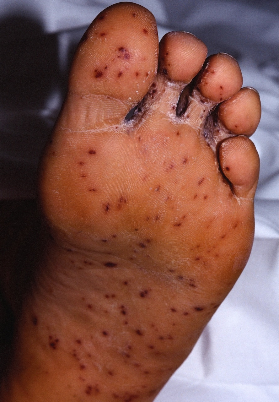 Measles