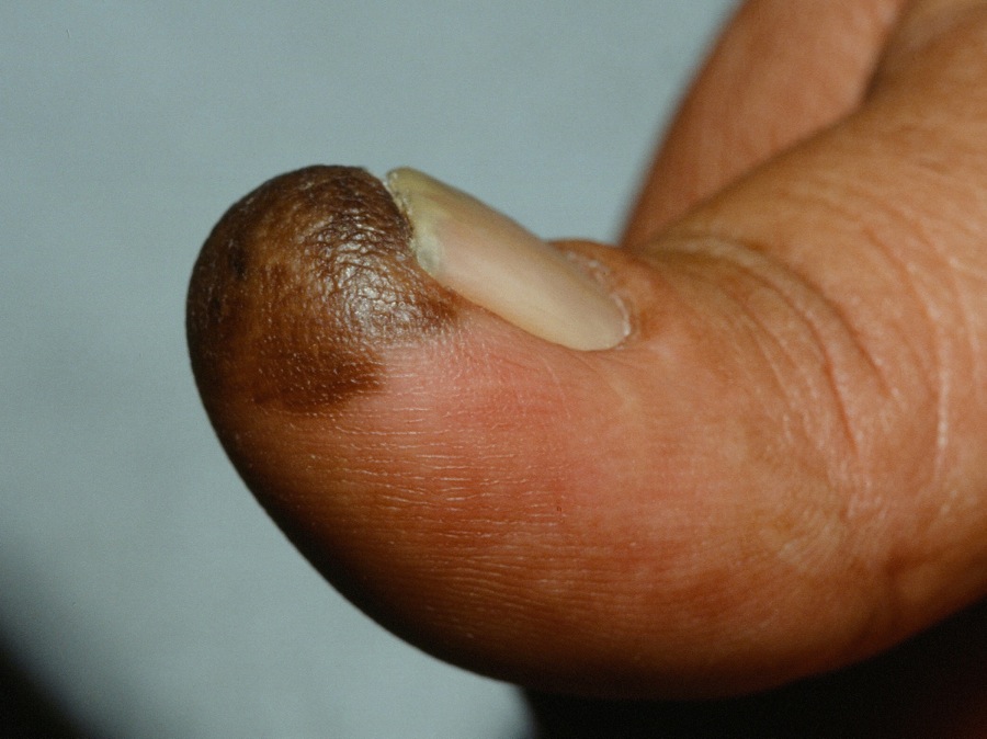 Melanoma Subungual