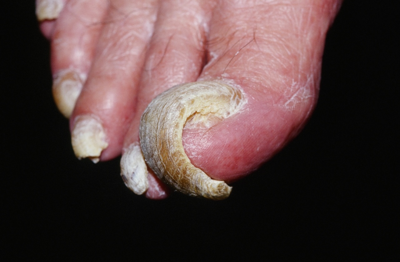 Onychogryphosis