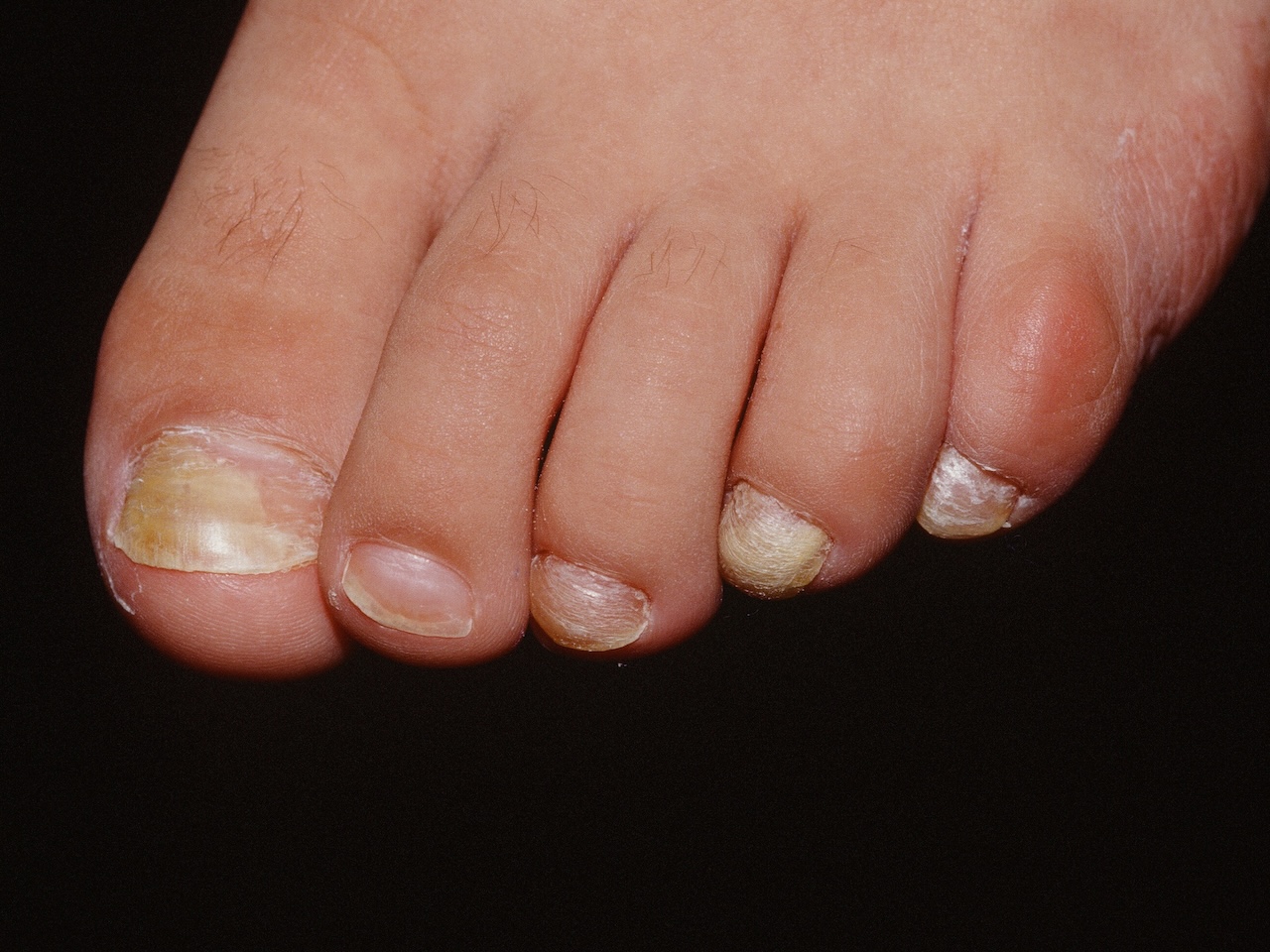 Onychomycosis