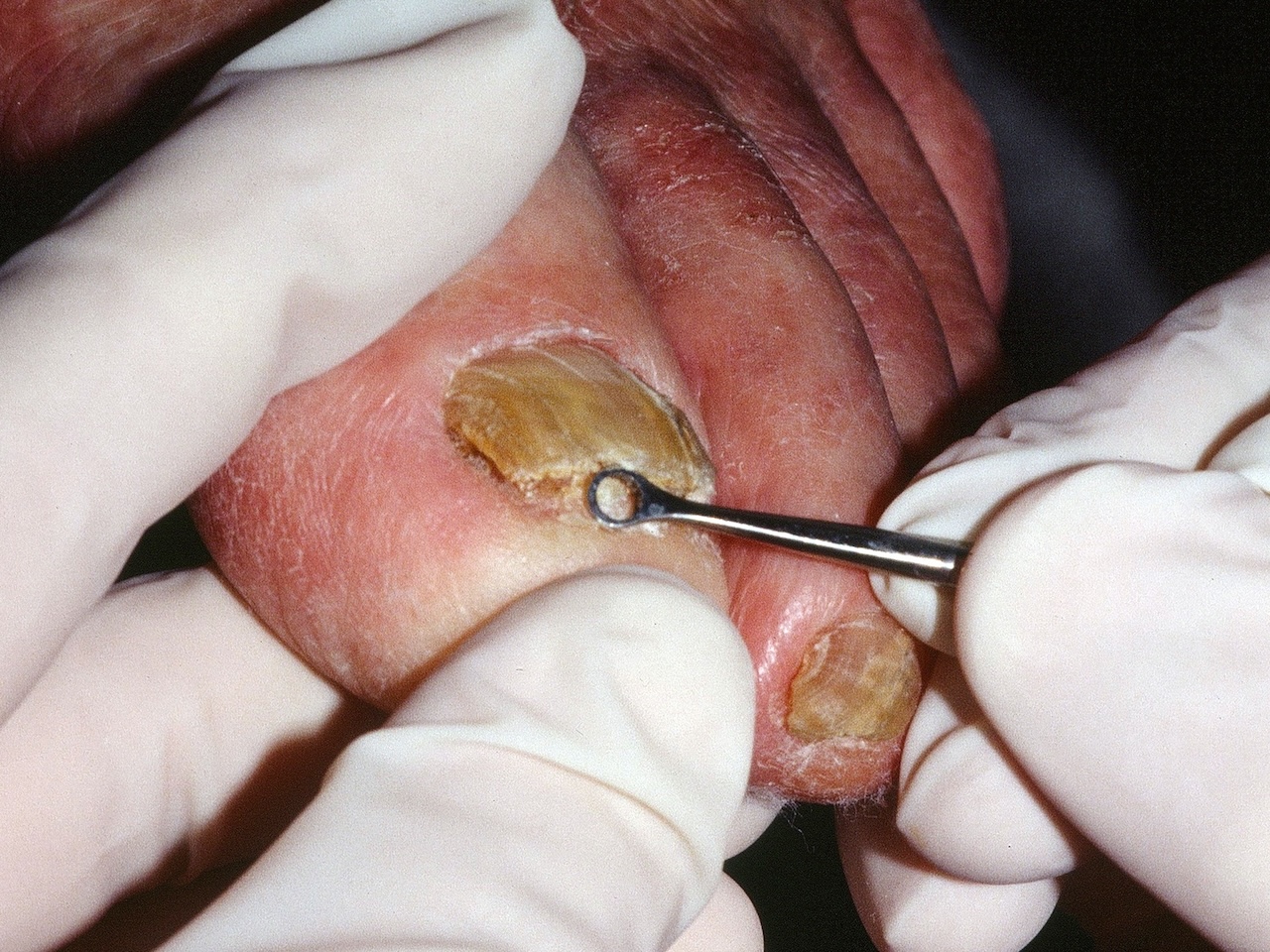 Onychomycosis