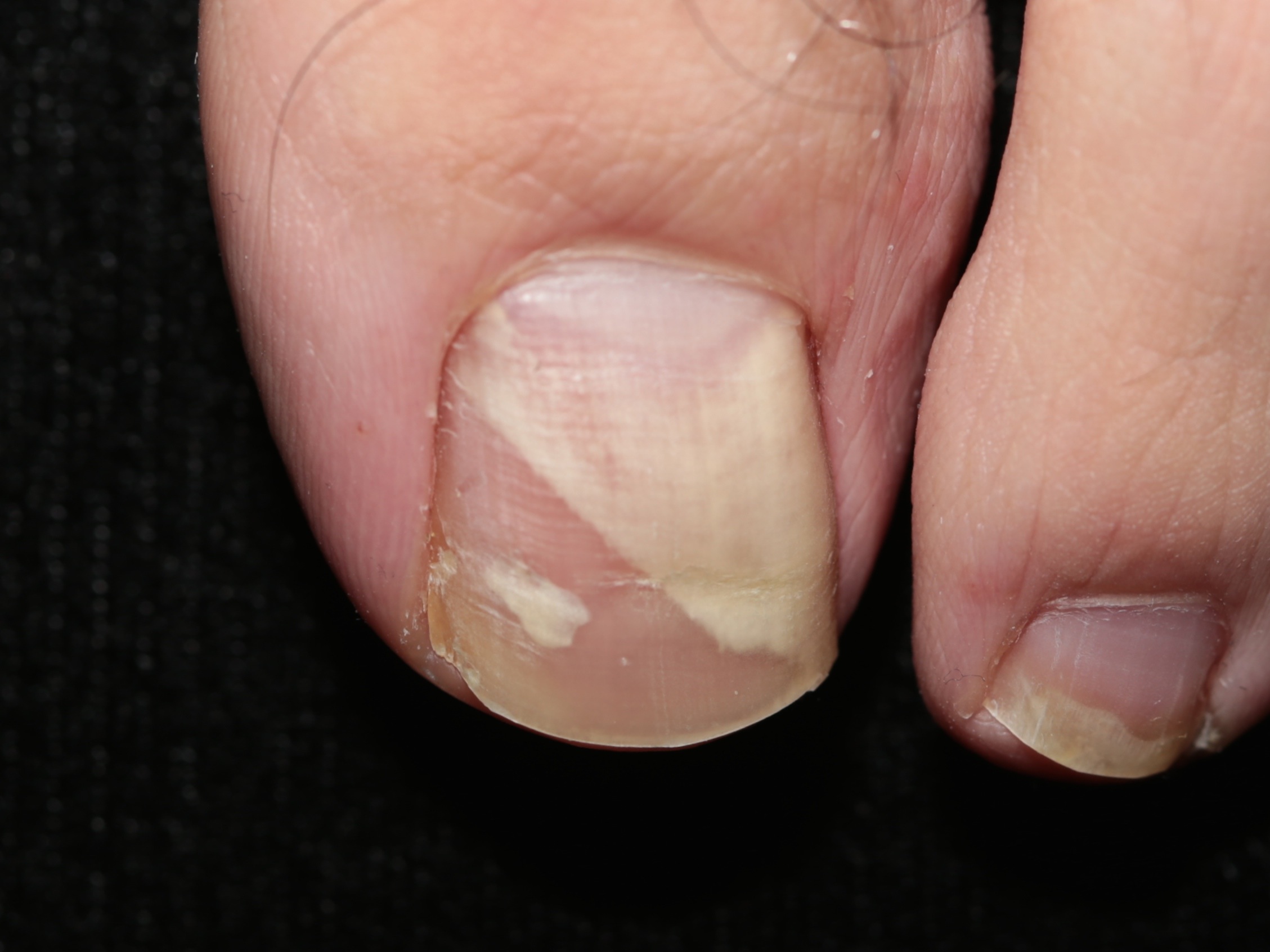 endonyx onychomycosis