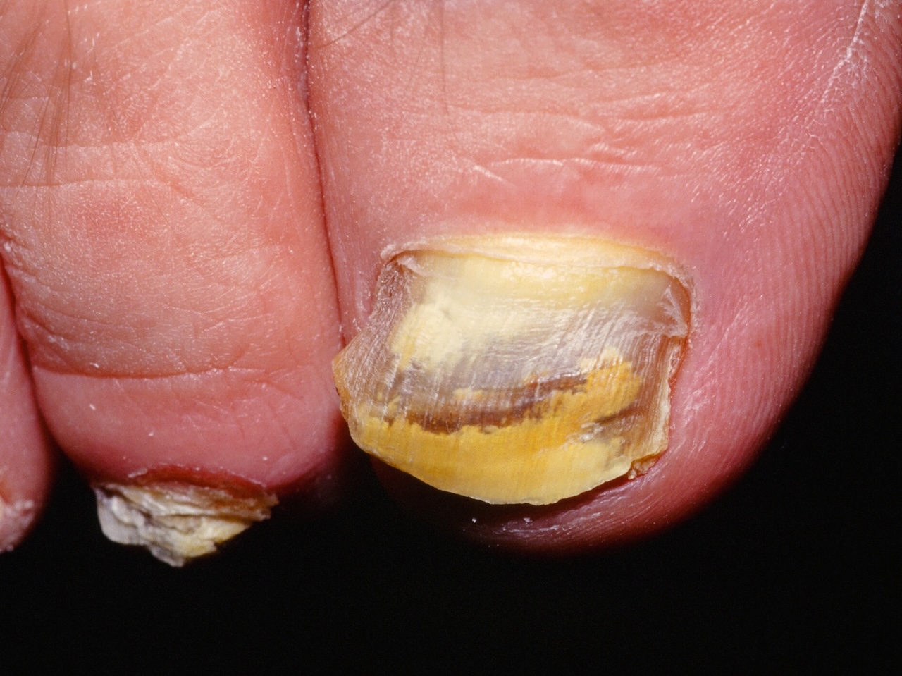 Onychomycosis