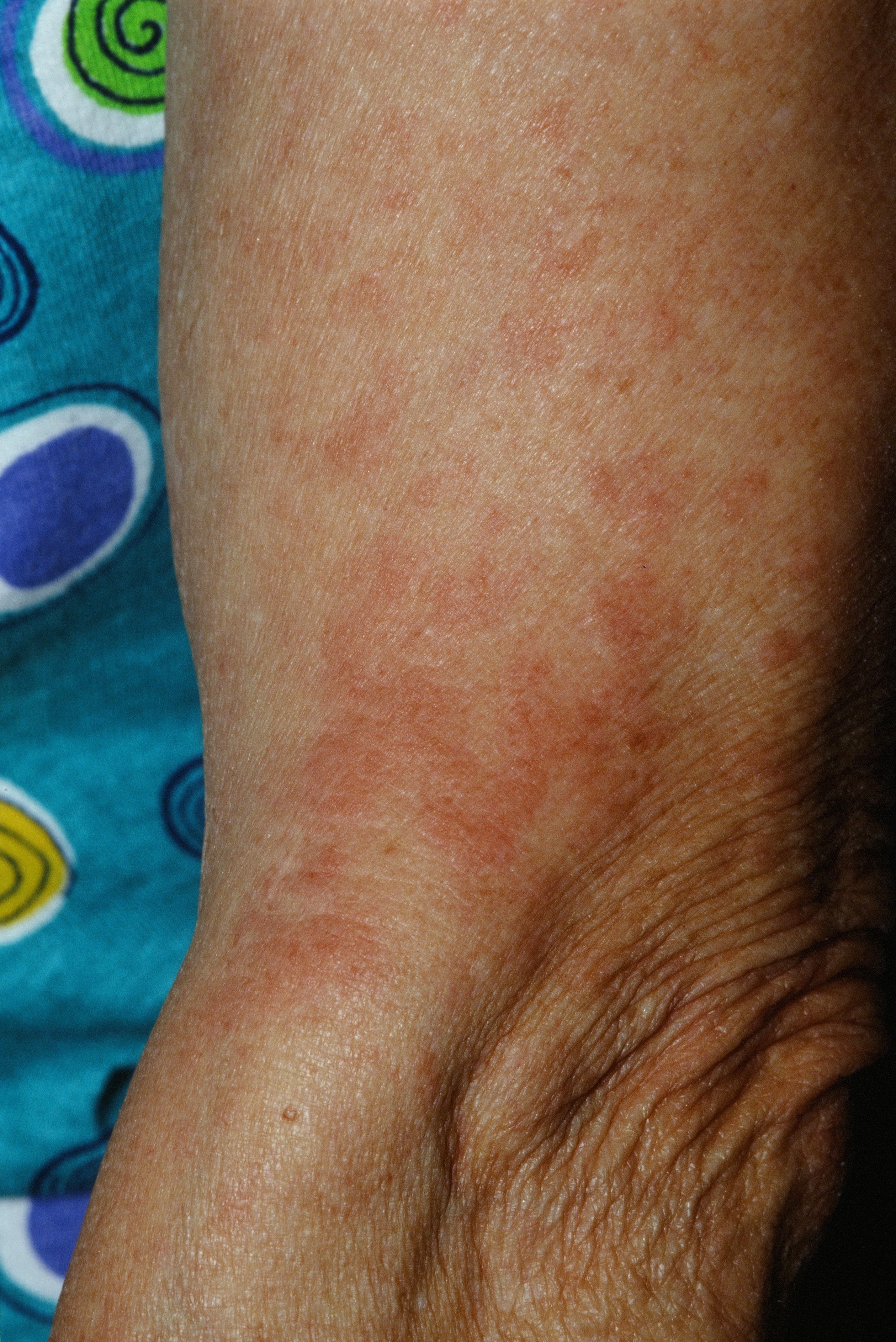 Polymorphous Light Eruption