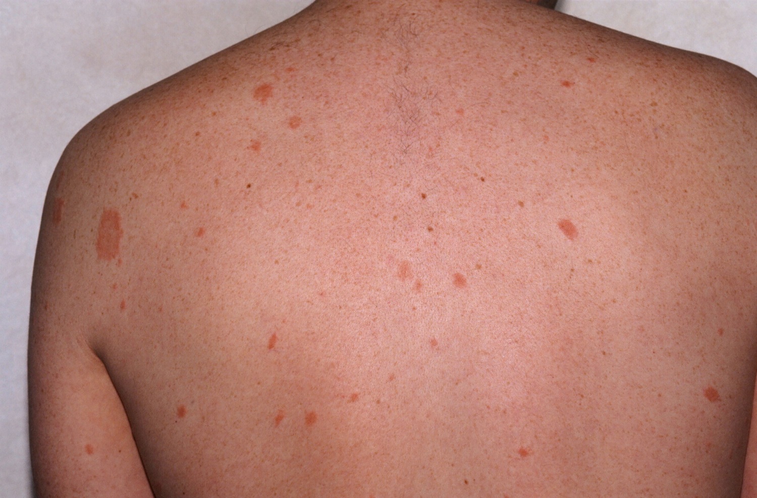 Pityriasis Rosea