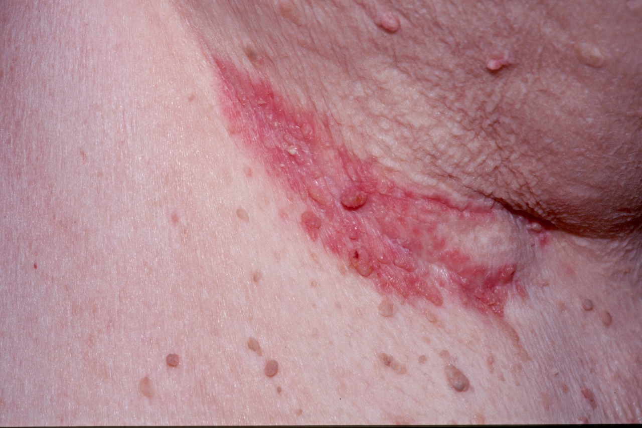 Seborrheic Dermatitis of the Axilla