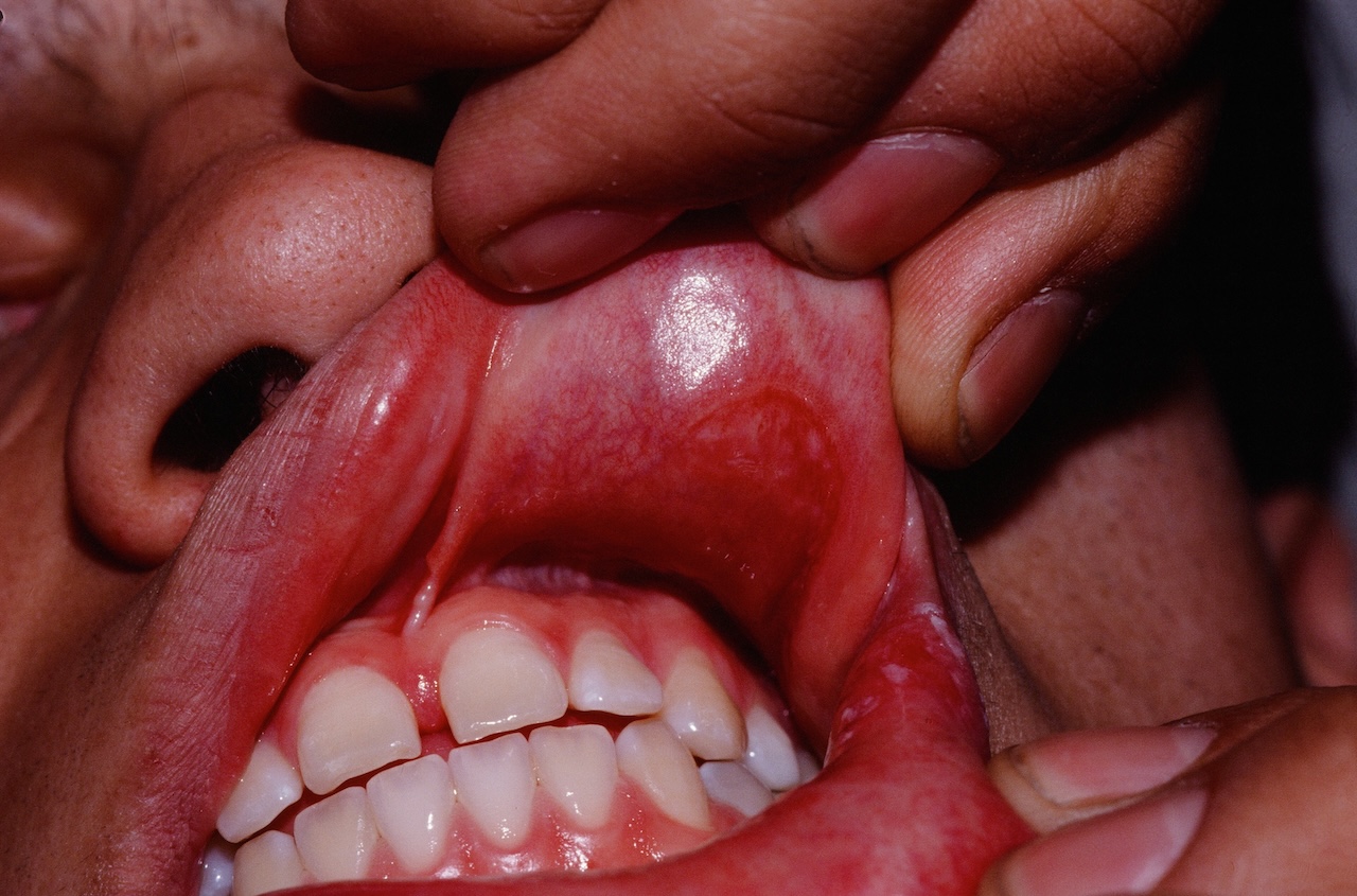 Secondary Syphilis