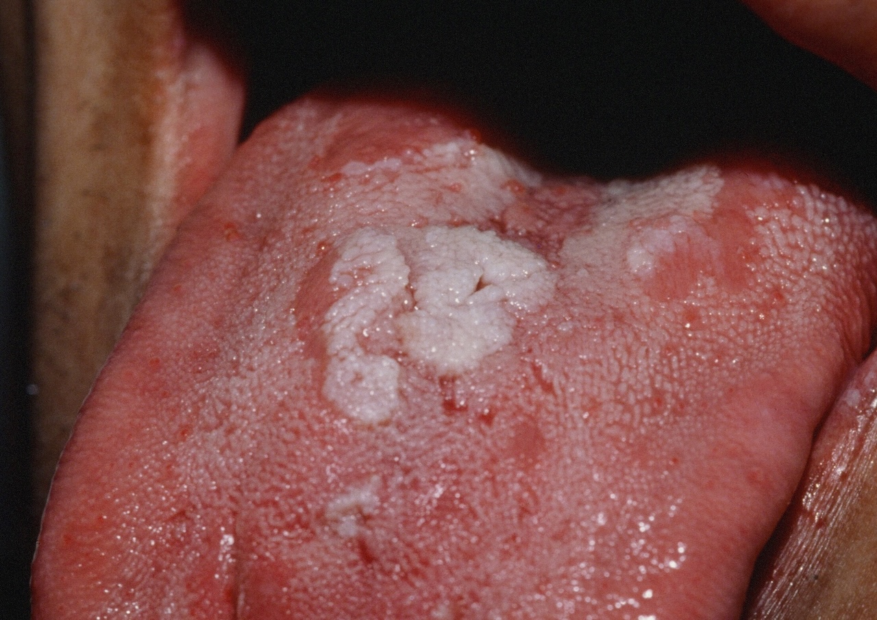 Secondary Syphilis