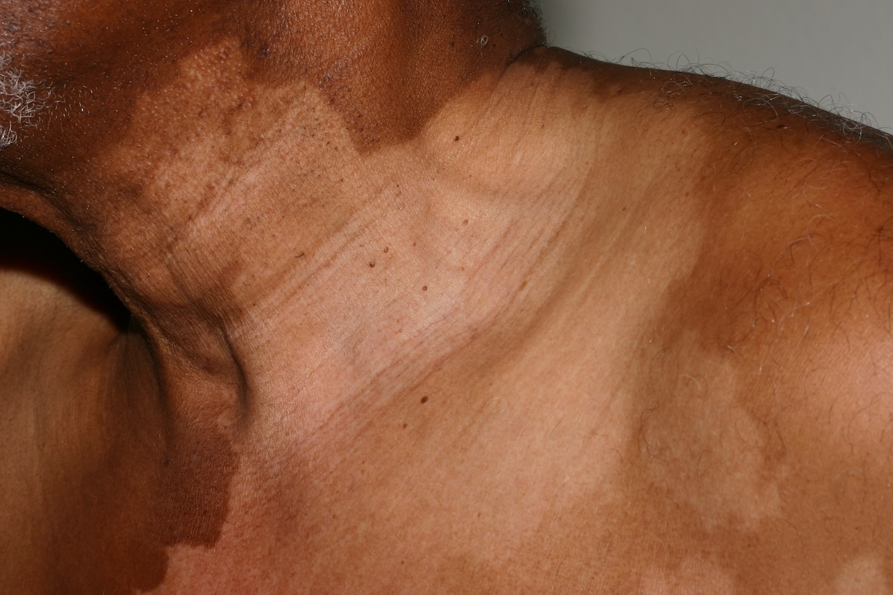 Segmental Vitiligo