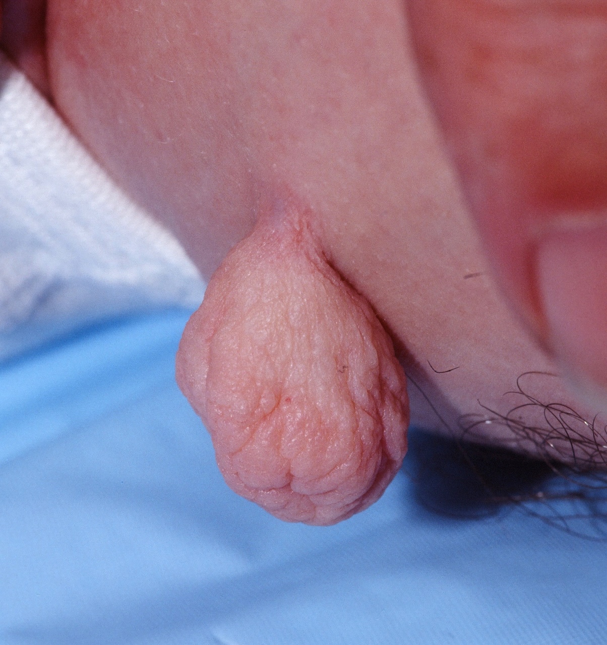 Skin Tag
