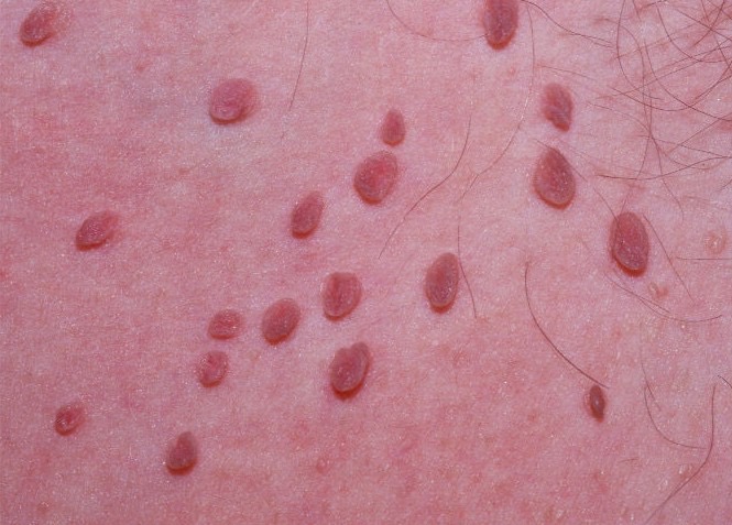 Skin tags