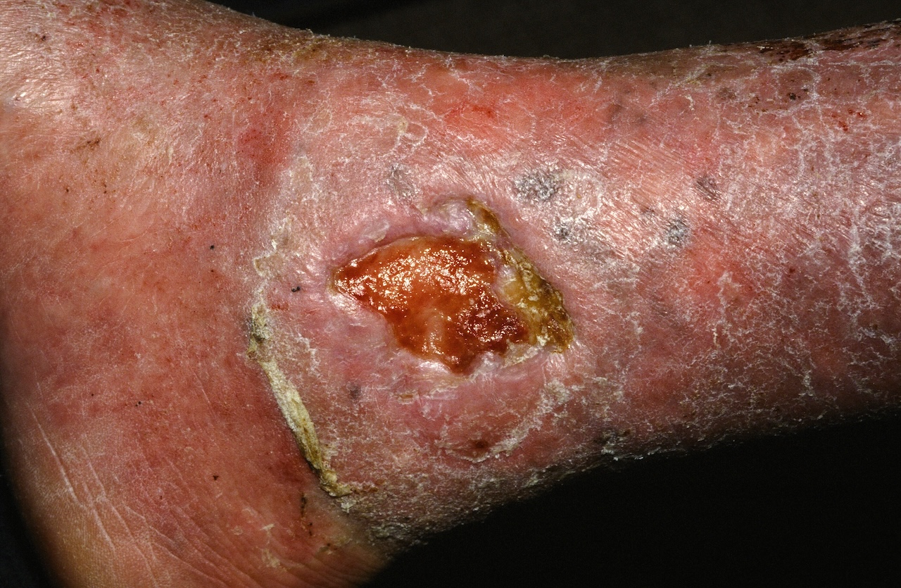 Stasis Ulcer