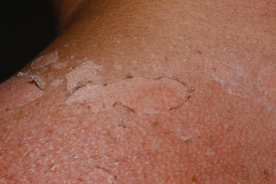 Desquamation after a sunburn