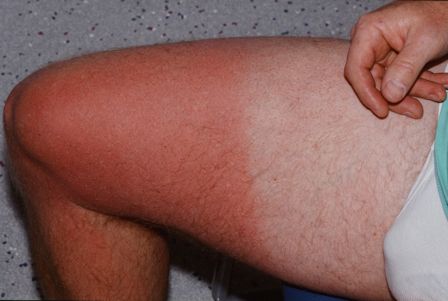 Sunburn on the thigh