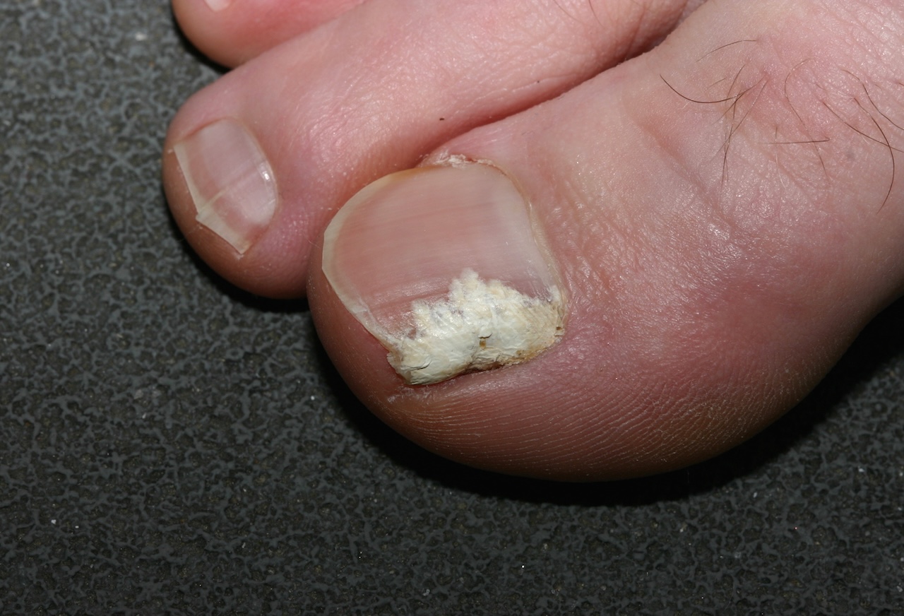 Superficial white onychomycosis