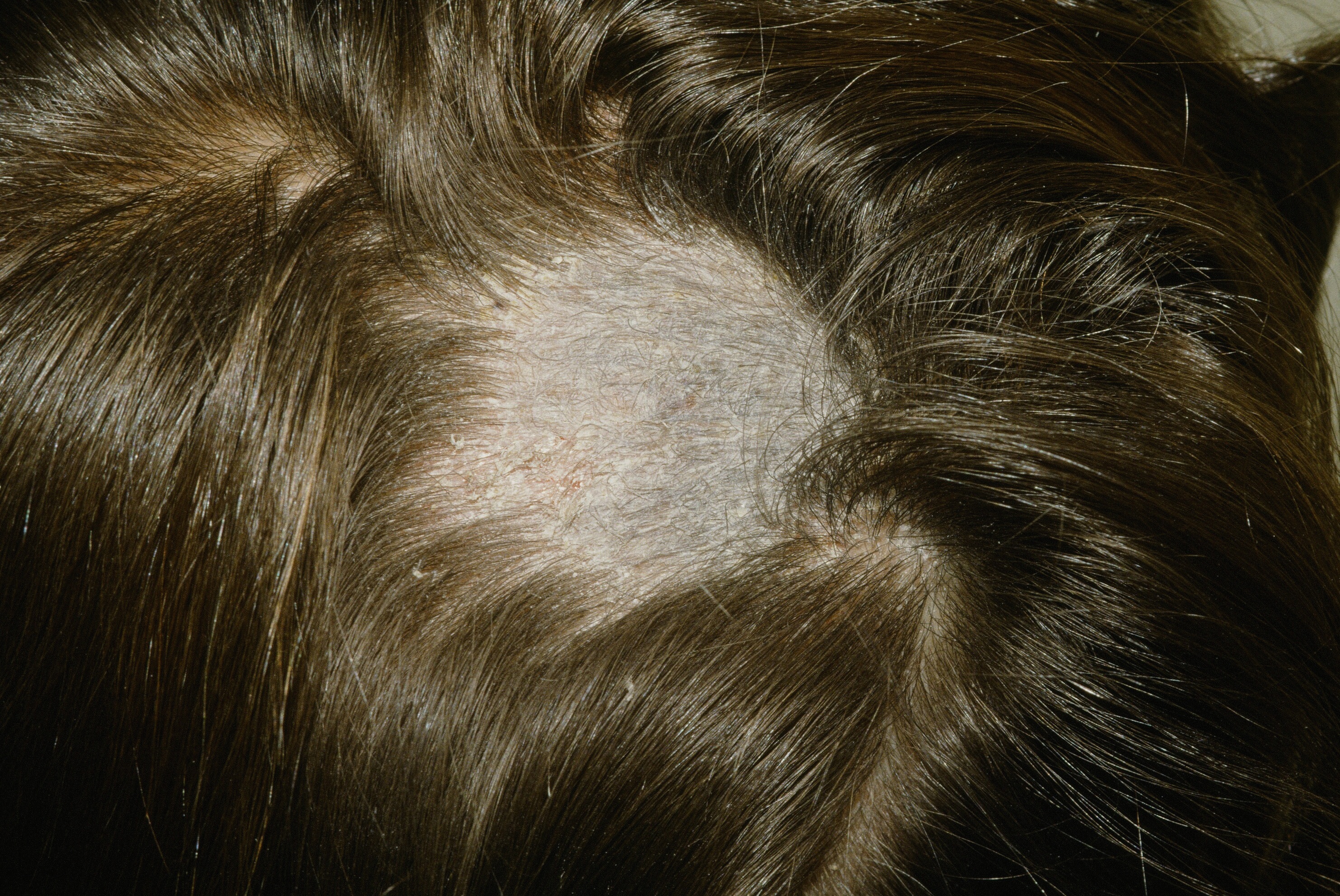 Tinea Capitis